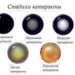 стадии течения катаракты у животного
